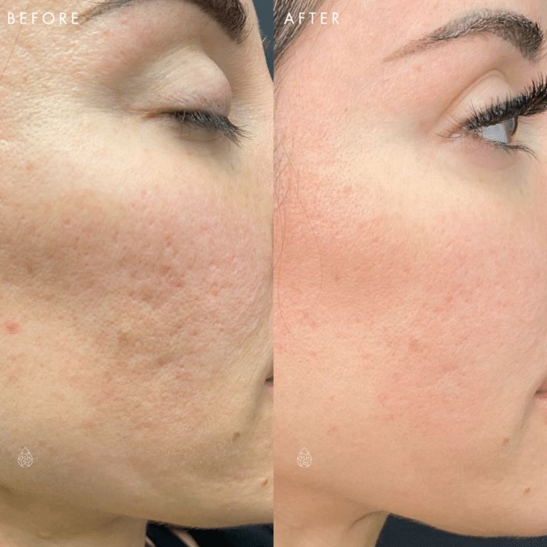 Before and after Microneedling + Exosomes