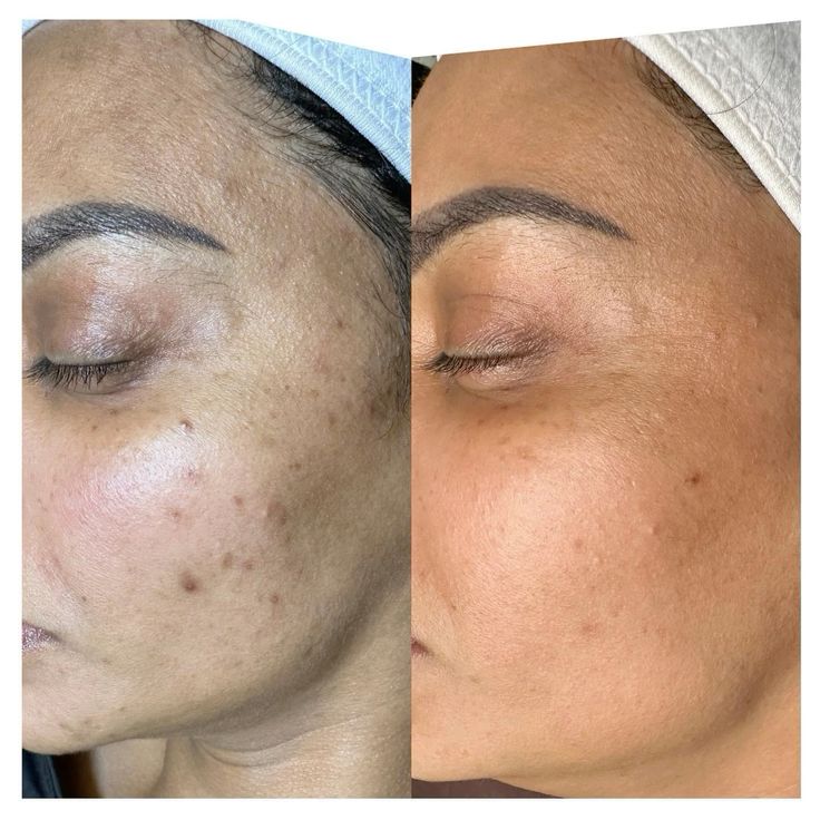 Before and after Microneedling + Exosomes