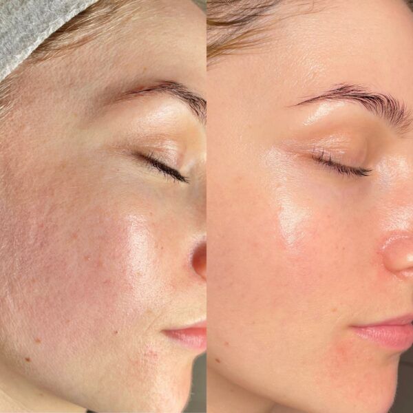 Before and after Signature Glow Renewal