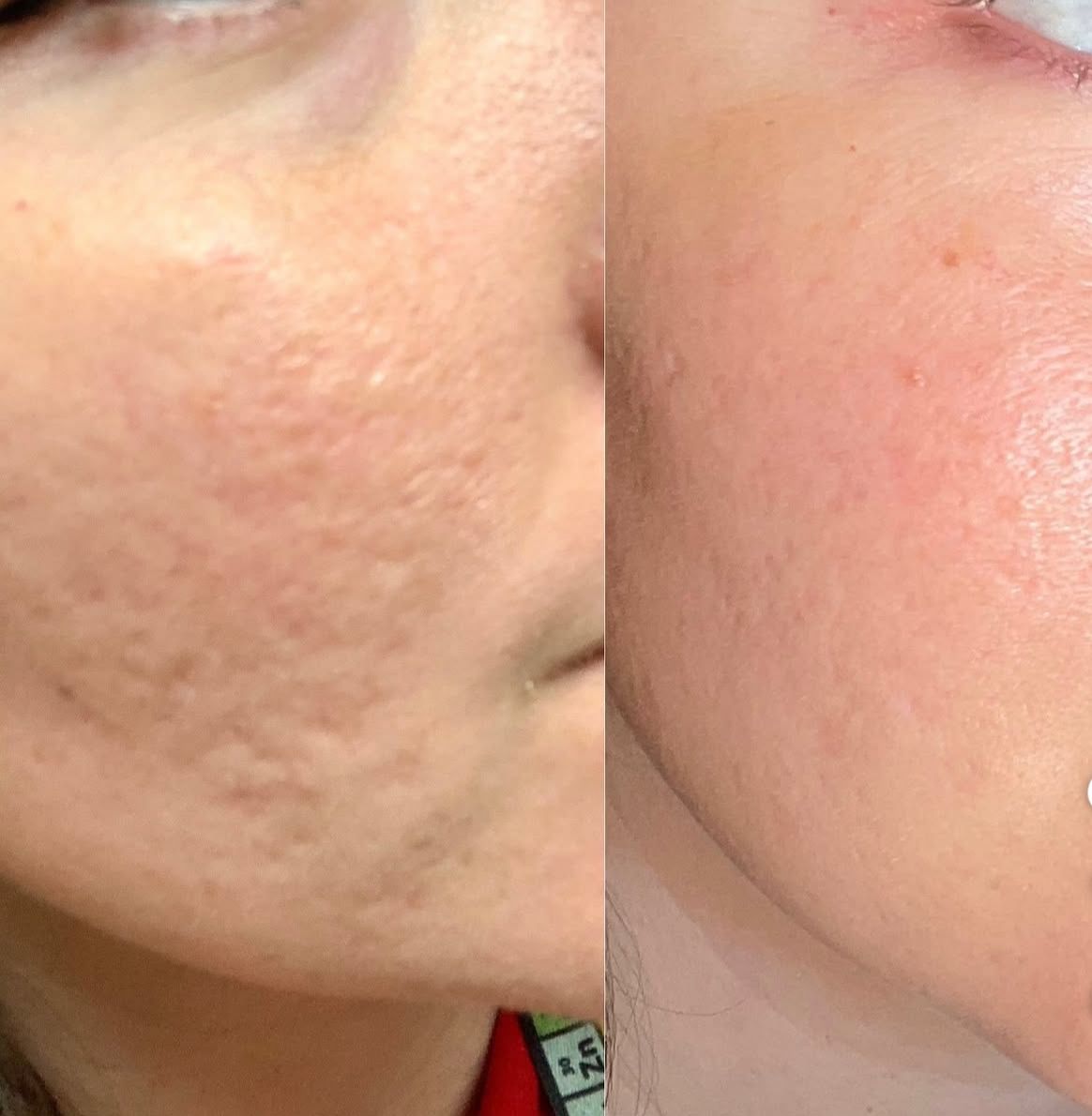 Before and after Exosome Skin Renewal